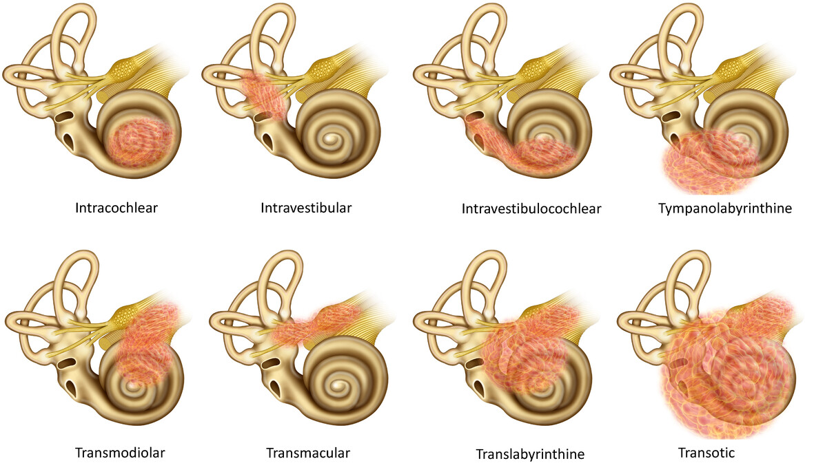 Cochlear Implant Outcomes in Patients with Intralabyrinthine Schwannoma: A Scoping Review