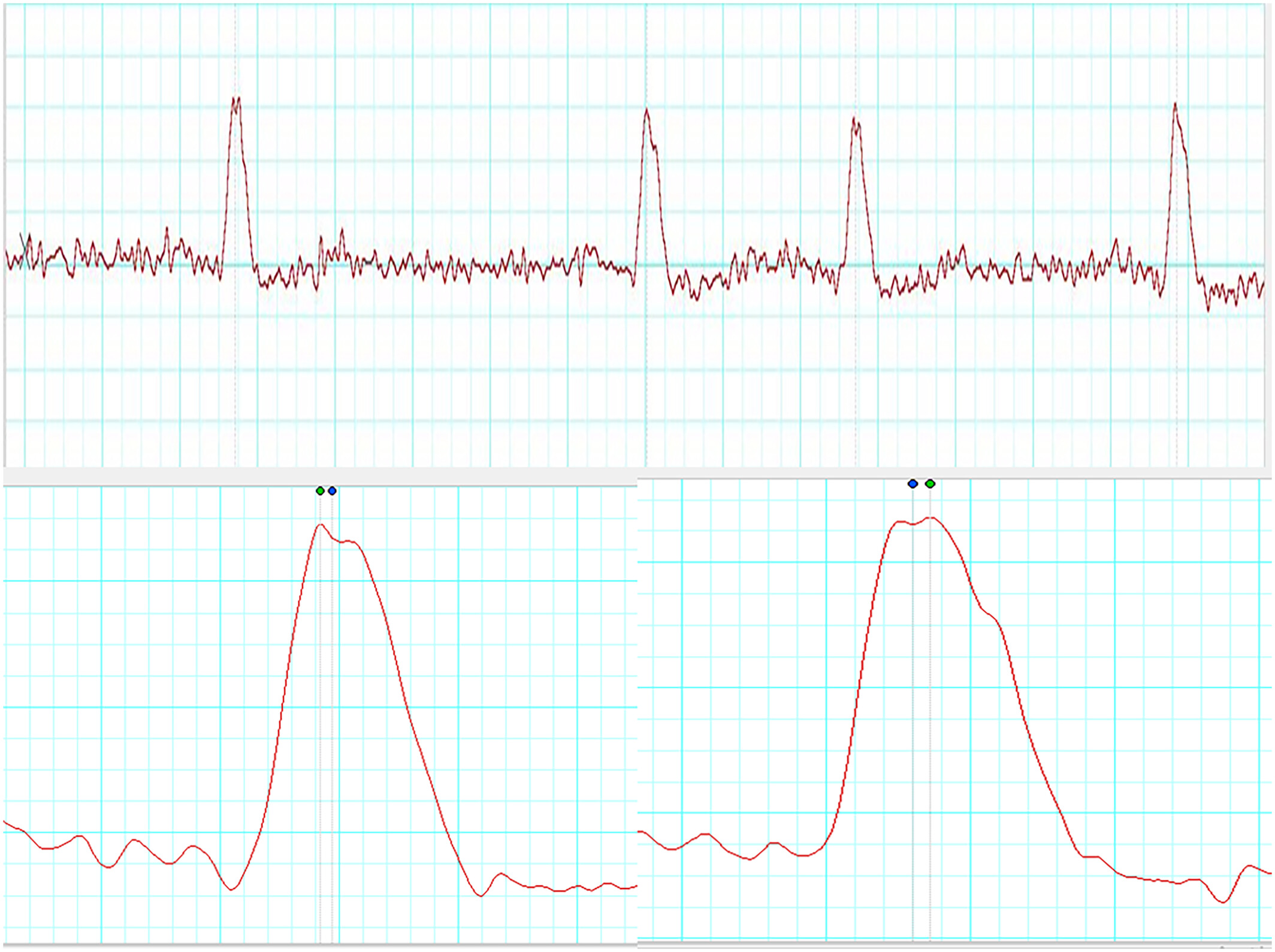 Bi-peaked R wave in HRV: A technical pitfall or ventricular pathology