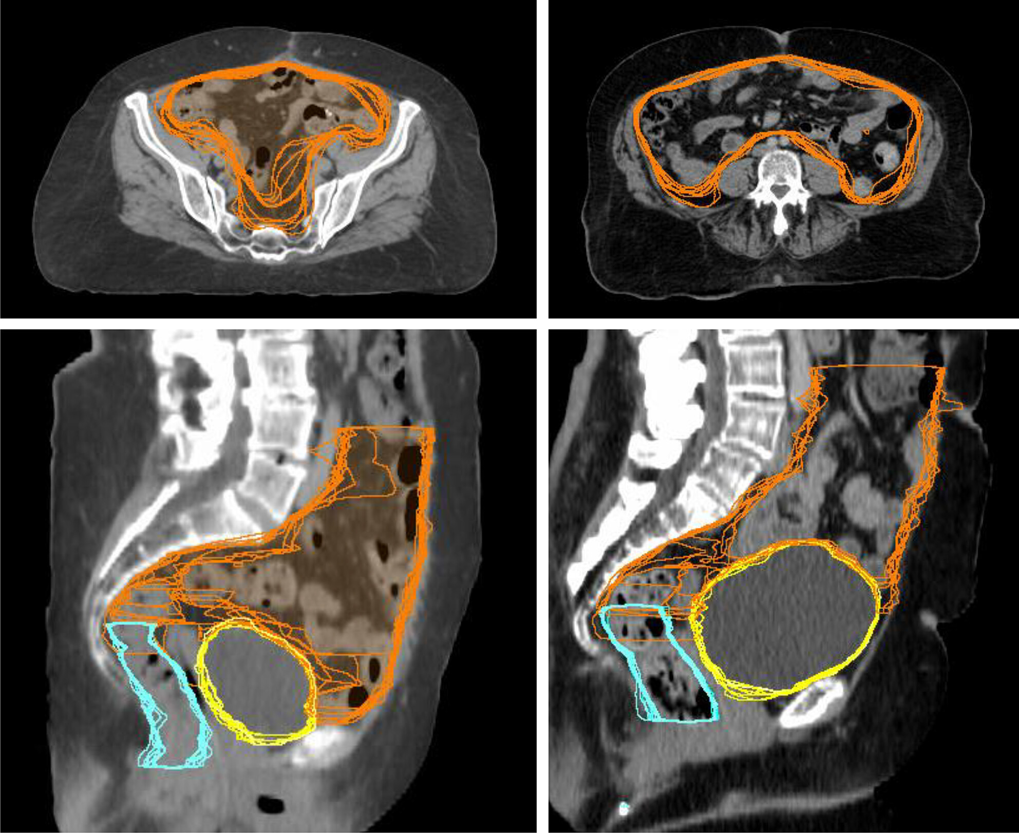 Impact of bowel space contouring variability on radiation dose and volume assessments in treatment planning for gynaecologic cancers