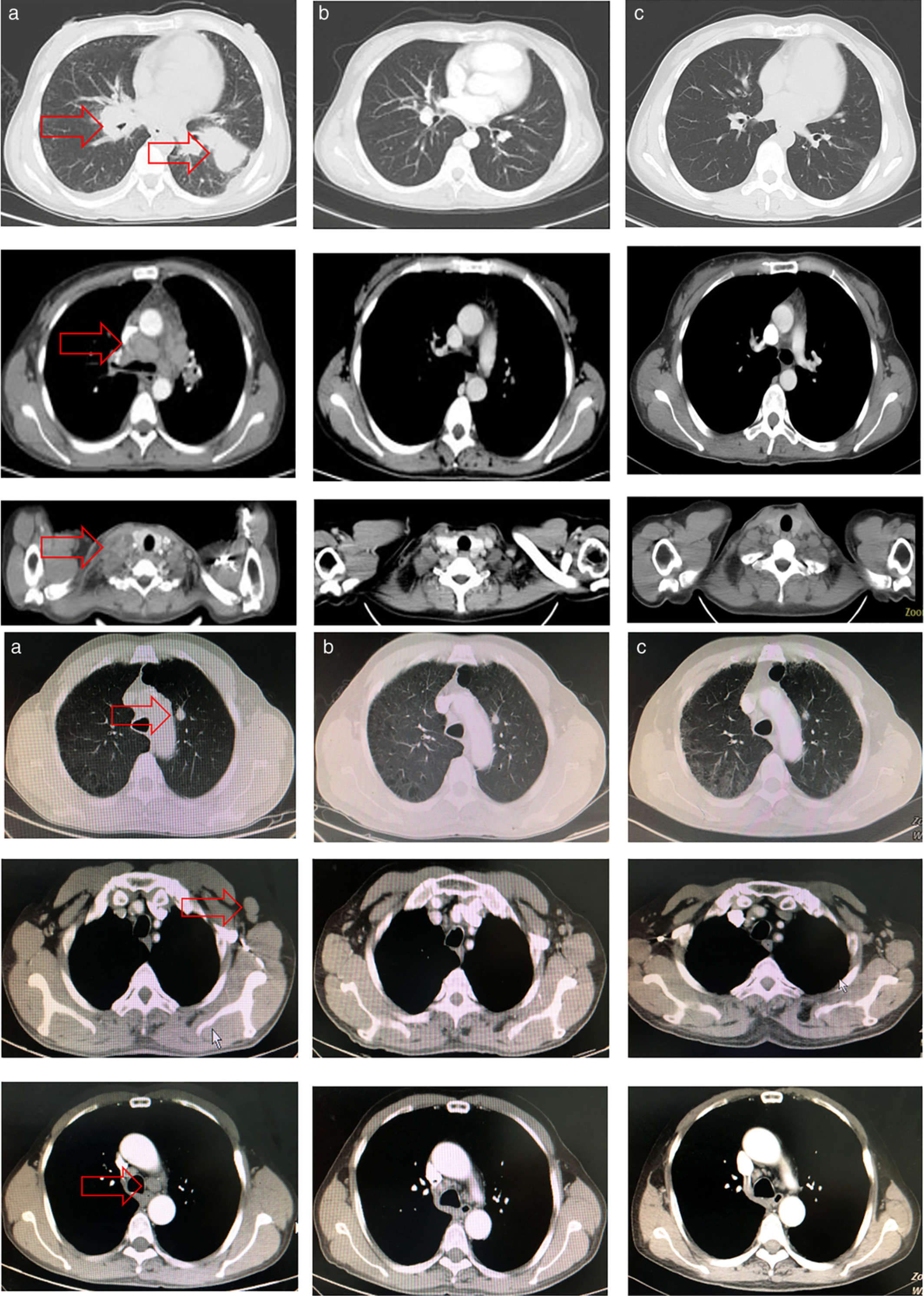 Duration of immunotherapy in patients with advanced lung adenocarcinoma with negative driver genes: case report and literature review