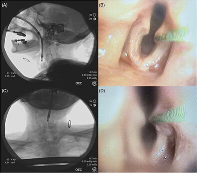 Clinician accuracy in identifying essential laryngeal landmarks on swallowing fluoroscopy