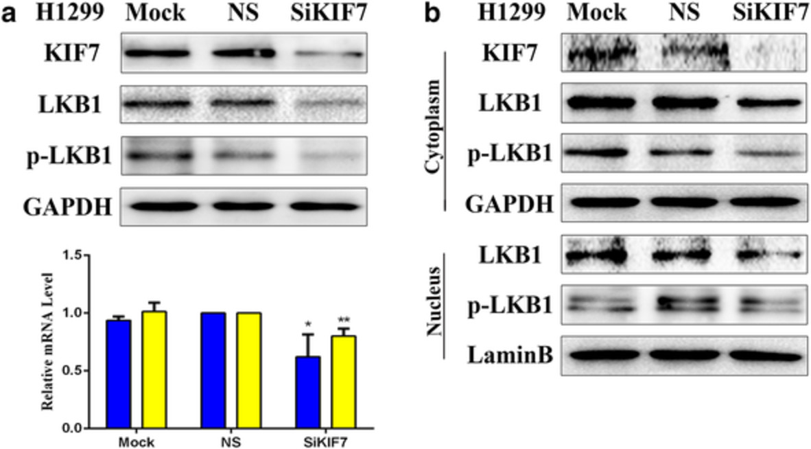 Human papillomavirus 16 (HPV 16) E6 but not E7 inhibits the antitumor activity of LKB1 in lung cancer cells by downregulating the expression of KIF7