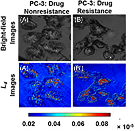 Optical study of chemotherapy efficiency in cancer treatment via intracellular structural disorder analysis using partial wave spectroscopy