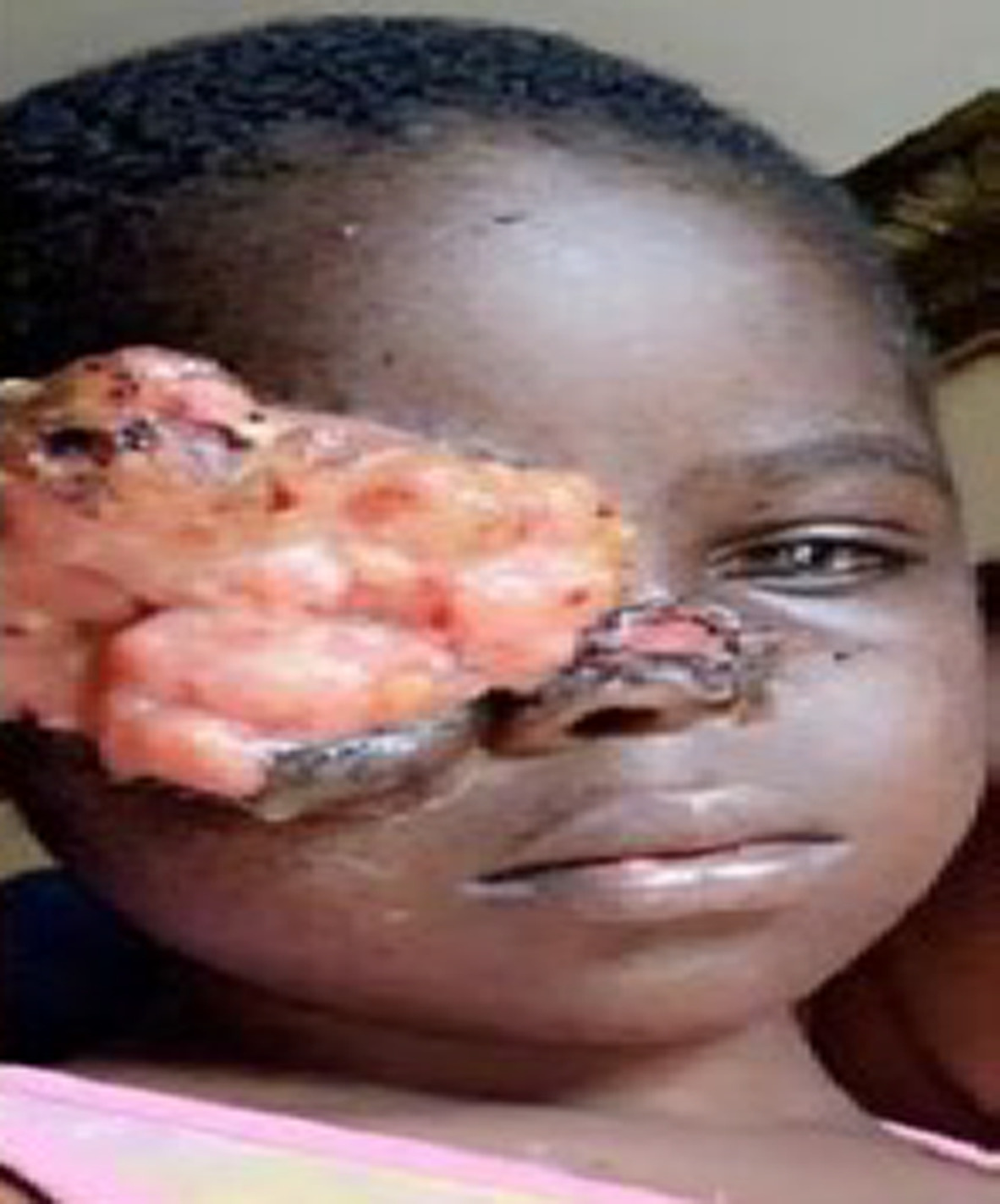Unresectable and chemoresistant conjunctival squamous cell carcinoma on xeroderma pigmentosum treated by salvage radiation therapy: A case report and a review of the literature