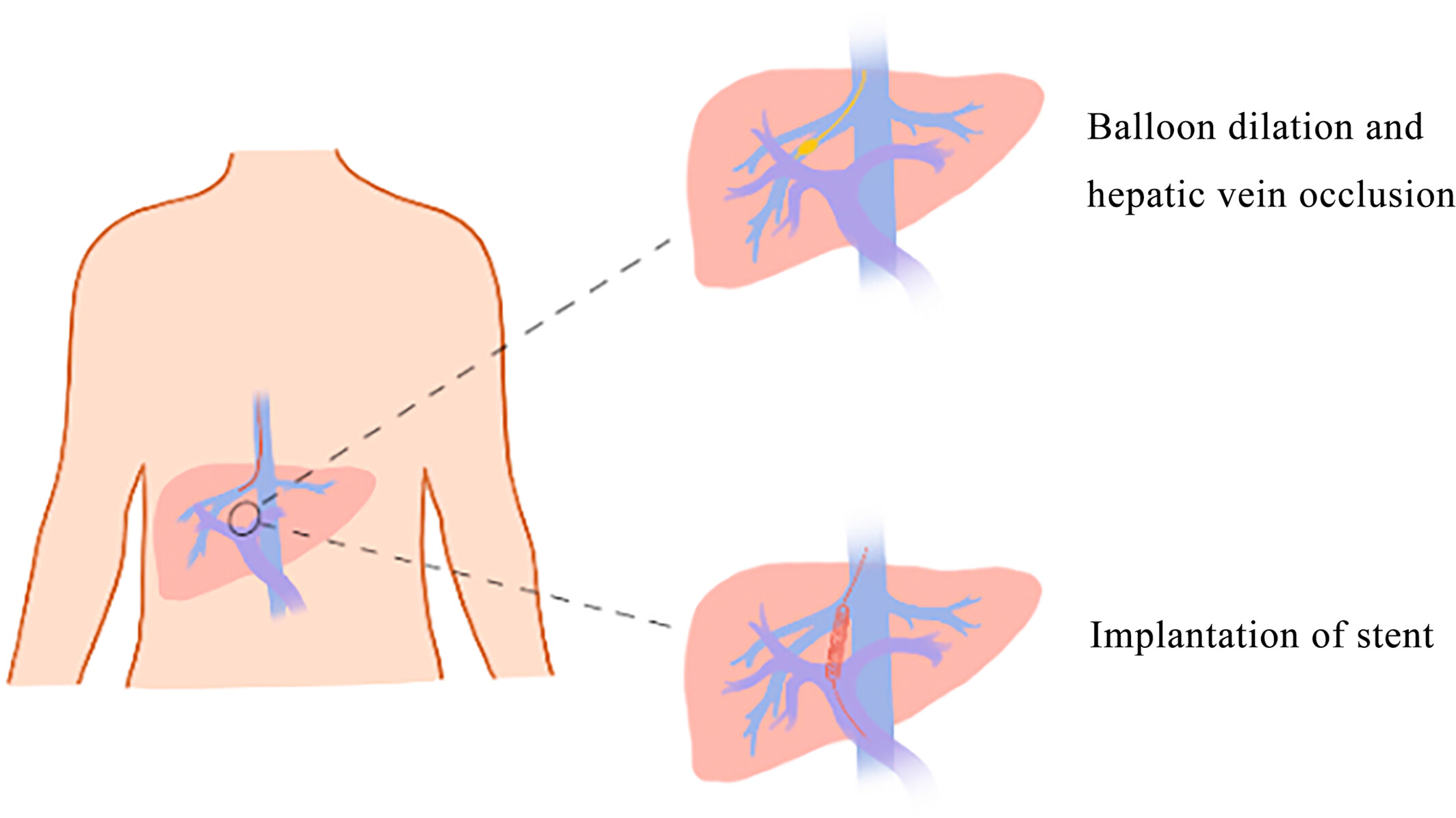 Correlation between hepatic venous pressure gradient and portal pressure gradient in patients with autoimmune cirrhotic portal hypertension and collateral branches of the hepatic vein
