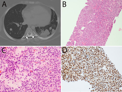 Clear cell stromal tumour of the lung with YAP1::TFE3 fusion: four cases including a case with highly aggressive clinical course
