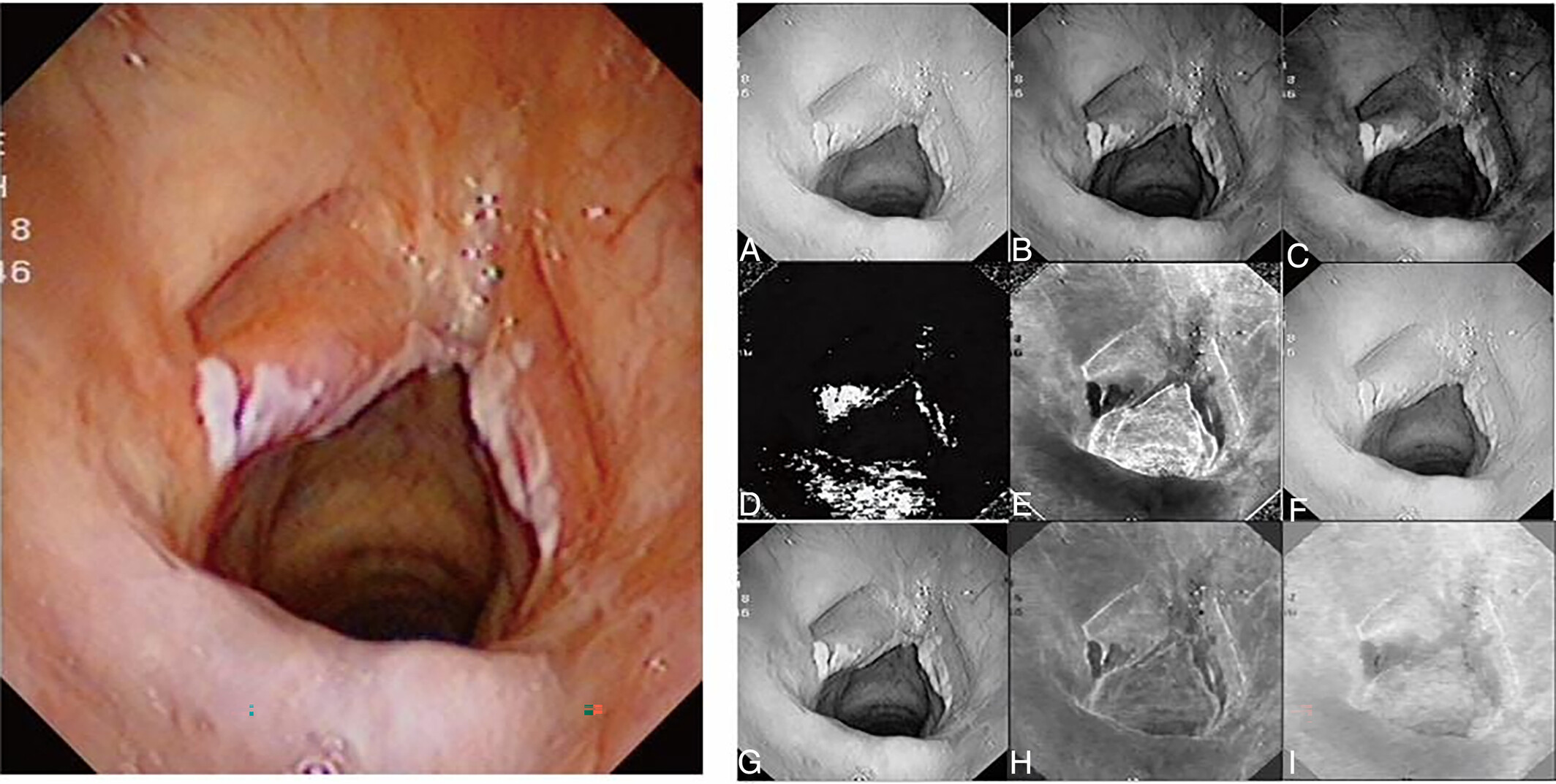 New Model and Public Online Prediction Platform for Risk Stratification of Vocal Cord Leukoplakia