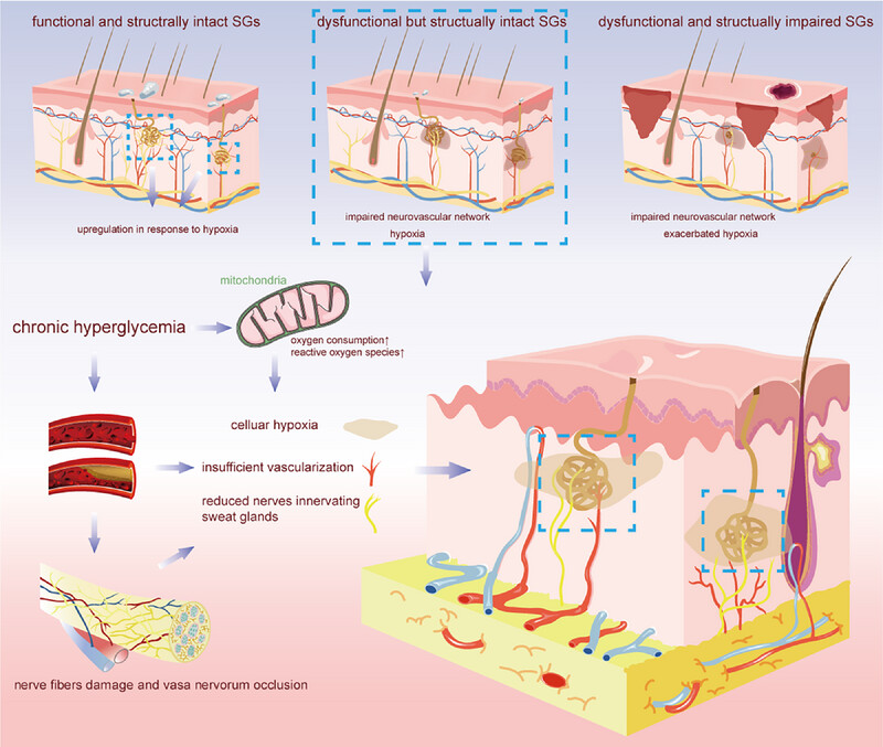 Hypoxia-Driven Neurovascular Impairment Underlies Structural-Functional Dissociation in Diabetic Sudomotor Dysfunction