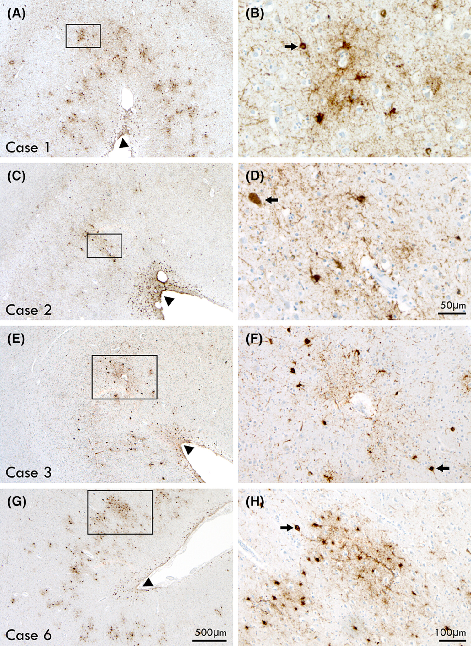 Chronic traumatic encephalopathy neuropathologic change in former Australian rugby players
