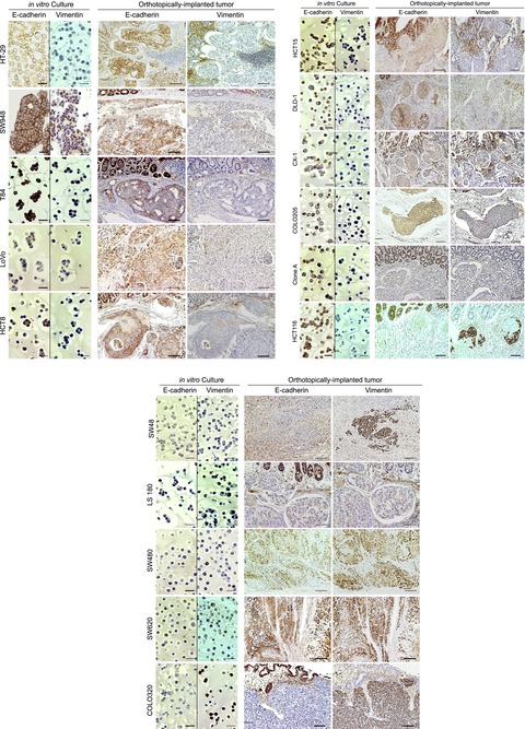 SERPINI1 regulates epithelial–mesenchymal transition in an orthotopic implantation model of colorectal cancer