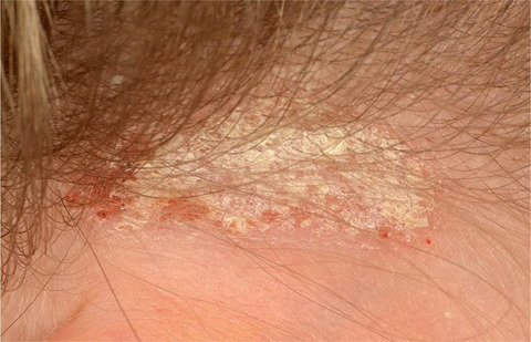 Identifying the best predictive diagnostic criteria for psoriasis in children (< 18 years): a UK multicentre case–control diagnostic accuracy study (DIPSOC study)*