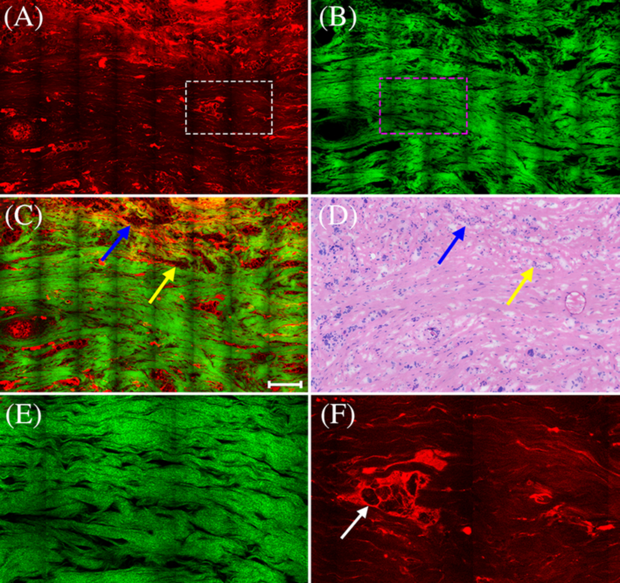 Evaluation of breast carcinoma regression after preoperative chemotherapy by label-free multiphoton imaging and image analysis