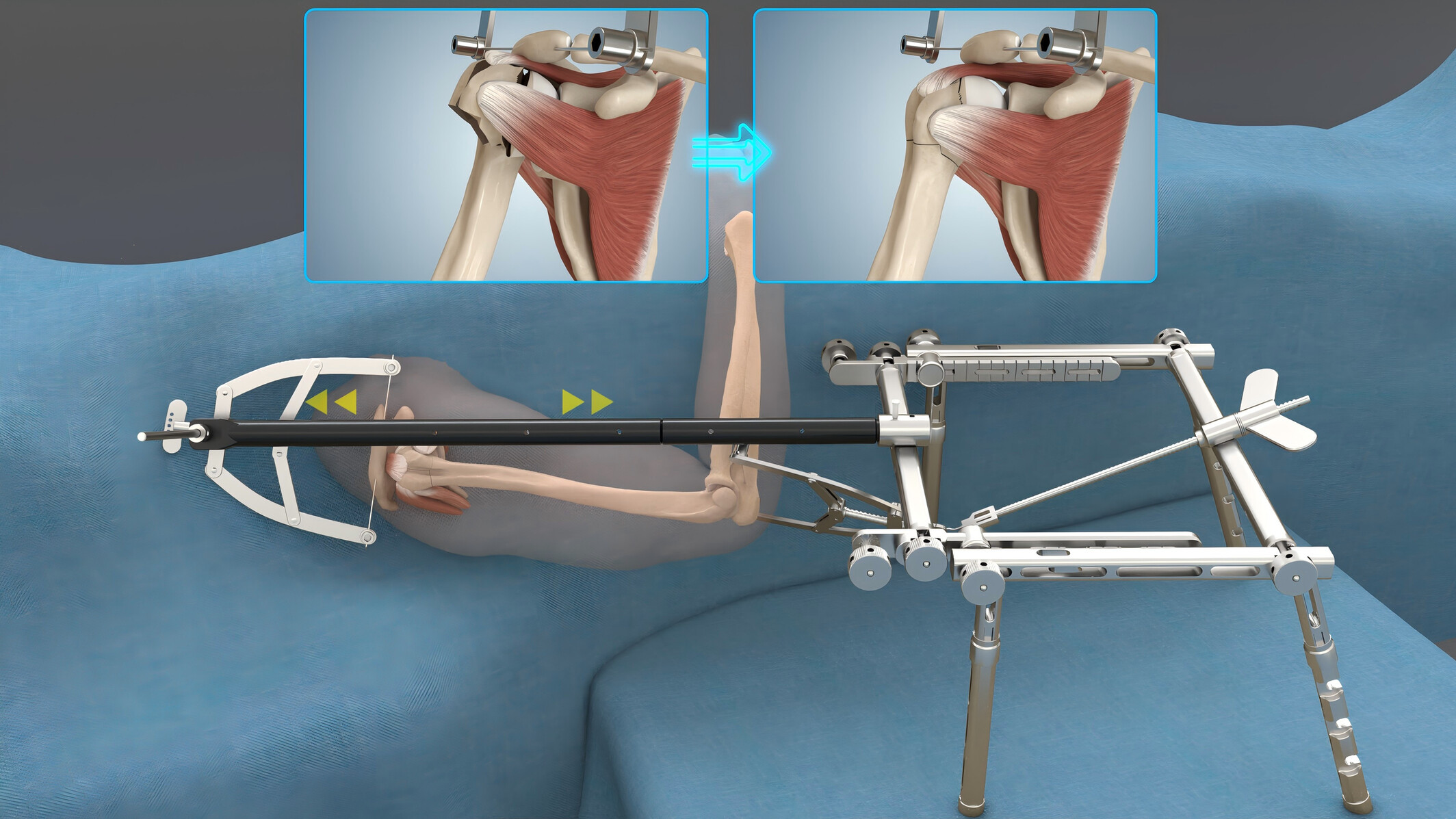 The Application of Bidirectional Rapid Reductor in Minimally Invasive Plate Osteosynthesis for the Treatment of Proximal Humeral Fractures: A Case Series
