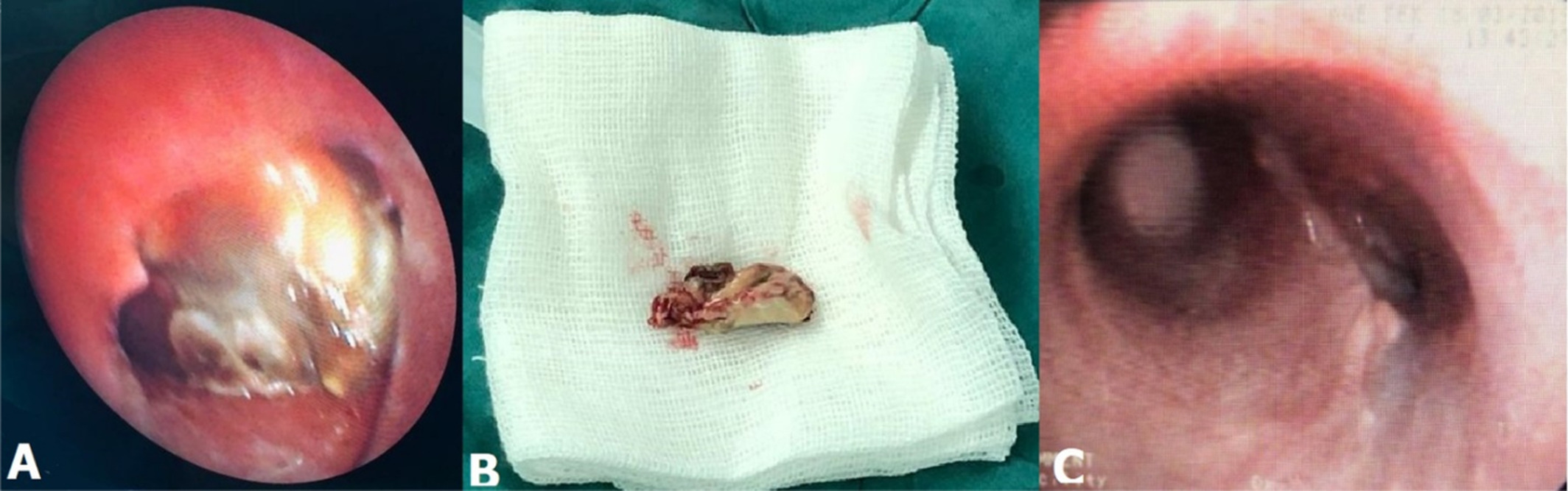 Near-Complete tracheal obstruction due to mucormycosis: A report of two cases