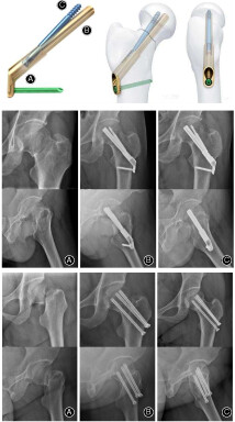 Comparison of Early Clinical Results for Femoral Neck System and Cannulated Screws in the Treatment of Unstable Femoral Neck Fractures