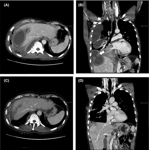 Empyema caused by transdiaphragmatic extension of pyogenic liver abscess