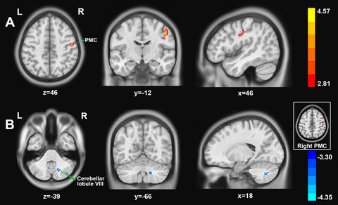 Abnormal dynamic brain activity and functional connectivity of primary motor cortex in blepharospasm