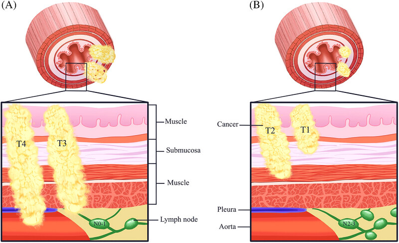 Exploration of individualized neoadjuvant therapy model for operable esophageal cancer: A Surveillance, Epidemiology, and End Results database analysis