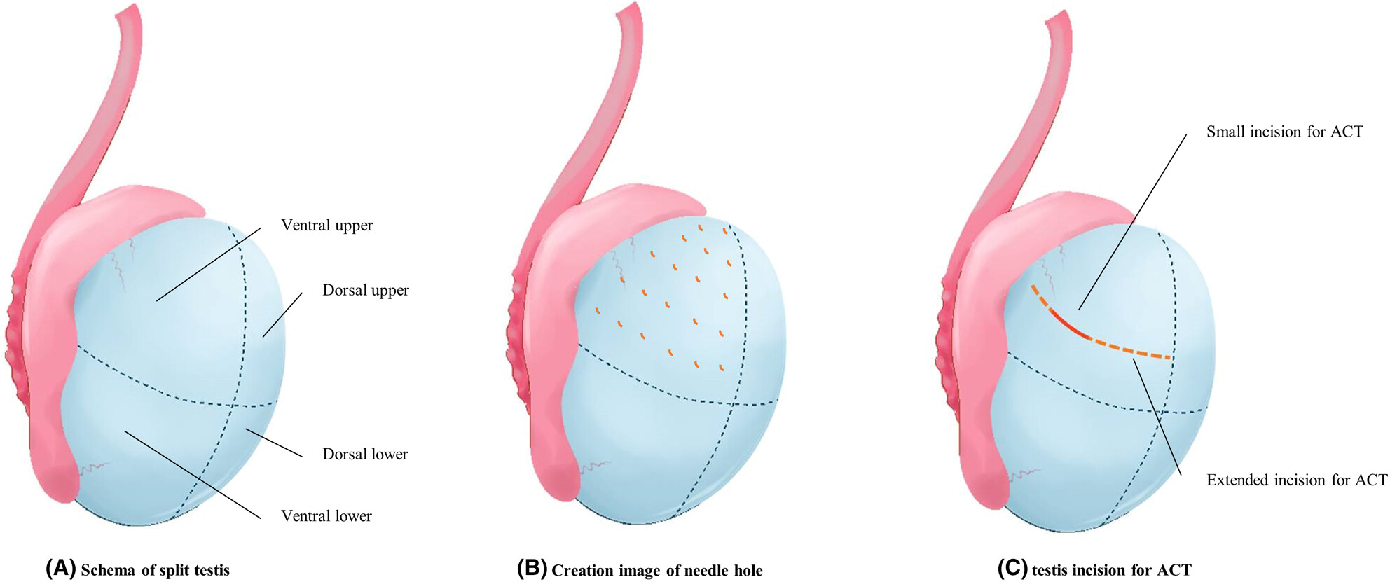 Micromapping testicular sperm extraction: A new technique for microscopic testicular sperm extraction in nonobstructive azoospermia