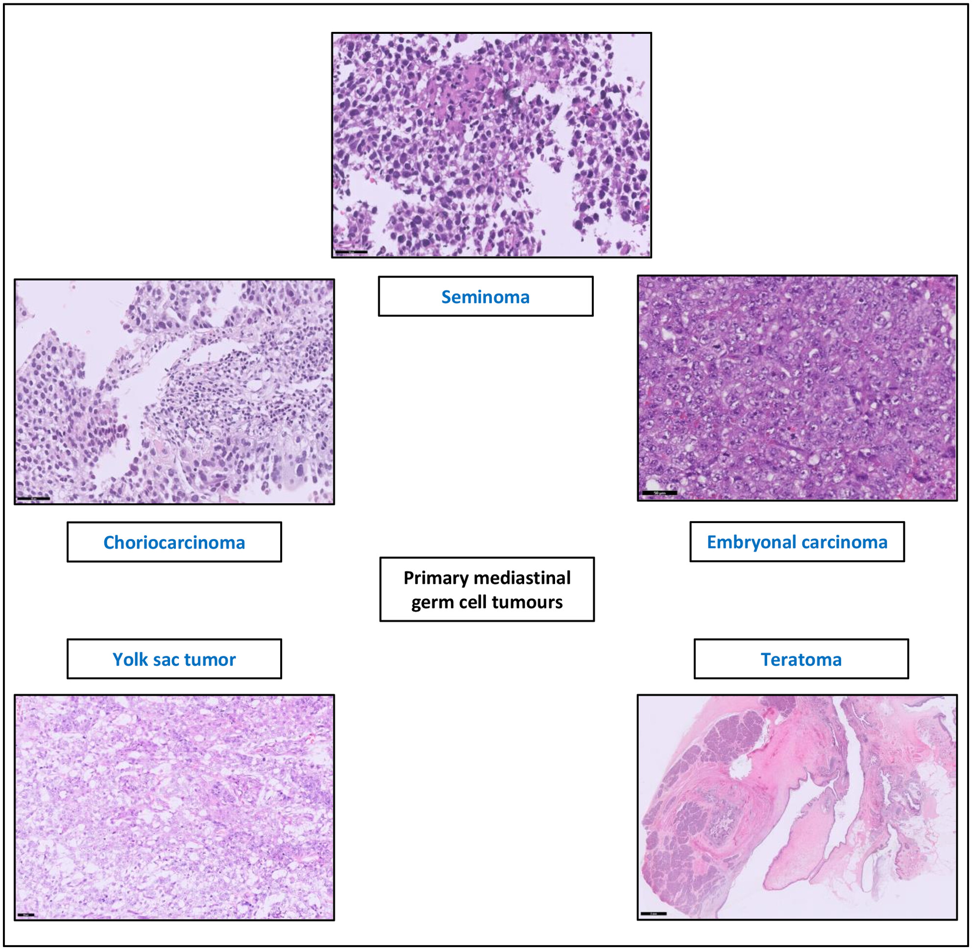 Primary germ cell tumours of the mediastinum: A review with emphasis on diagnostic challenges