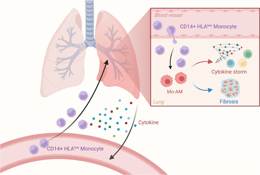 Monocyte–macrophage dynamics as key in disparate lung and peripheral immune responses in severe anti-melanoma differentiation-associated gene 5-positive dermatomyositis-related interstitial lung disease