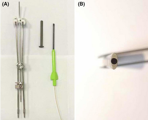 Preliminary report of a single-channel applicator in high dose rate afterloading brachytherapy for cervical cancer