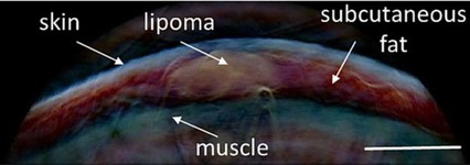 Imaging of fatty tumors: appearance of subcutaneous lipomas in optoacoustic images
