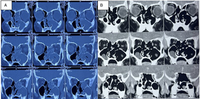 Prolonged Itraconazole Therapy as Sole Treatment for Patients with Allergic Fungal Rhinosinusitis