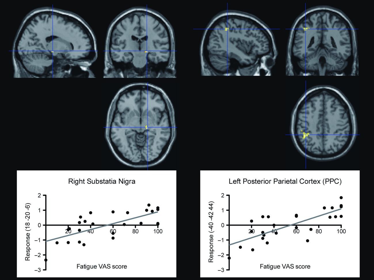 Thalamo-striato-cortical determinants to fatigue in multiple sclerosis