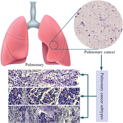 3D-PulCNN: Pulmonary cancer classification from hyperspectral images using convolution combination unit based CNN