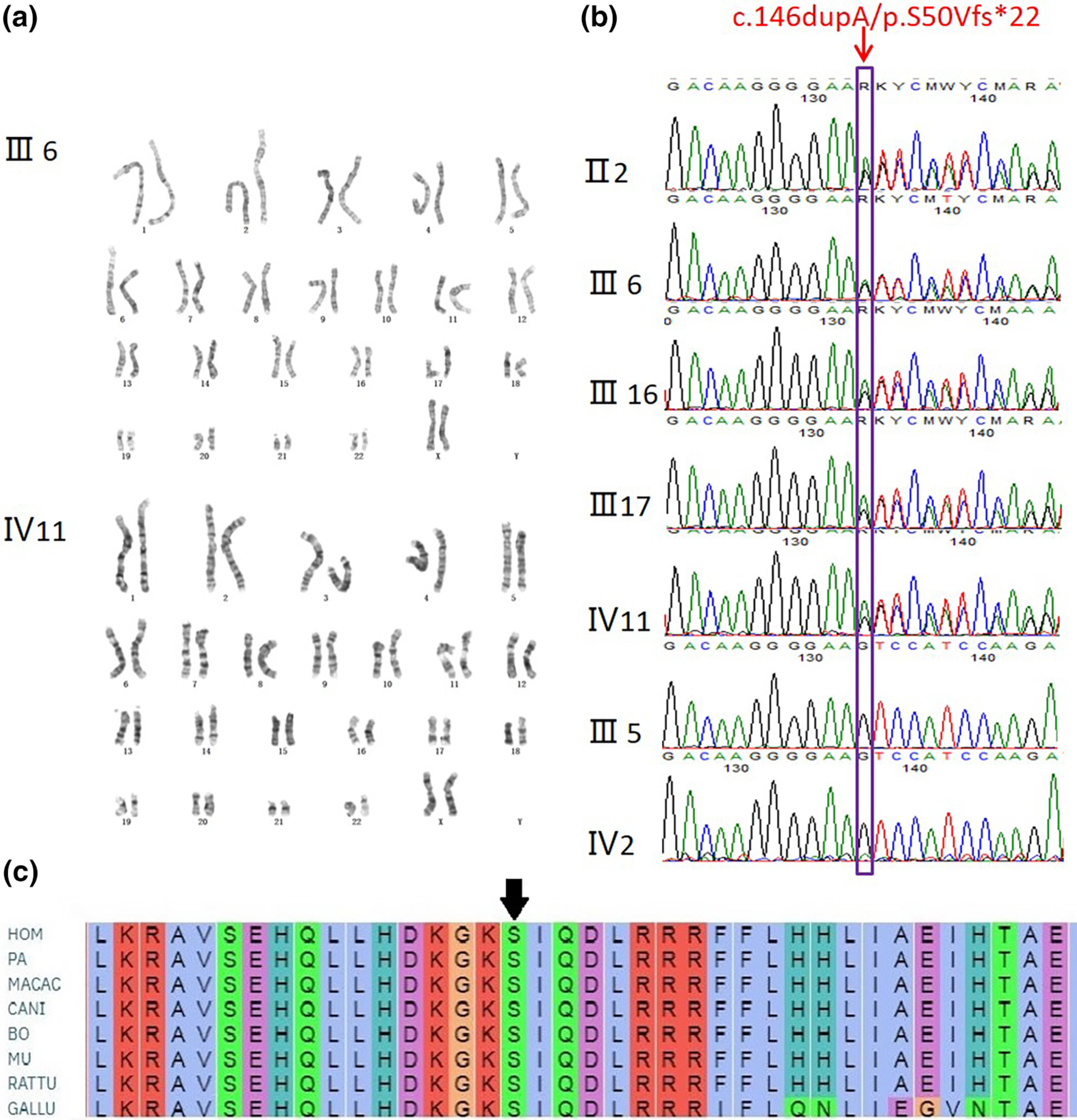 A novel heterozygous mutation in PTHLH causing autosomal dominant brachydactyly type E complicated with short stature