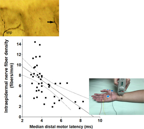 Early changes of nerve integrity in preclinical carriers of hereditary transthyretin Ala117Ser amyloidosis with polyneuropathy