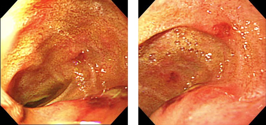 Henoch–Schönlein purpura with preceding abdominal pain