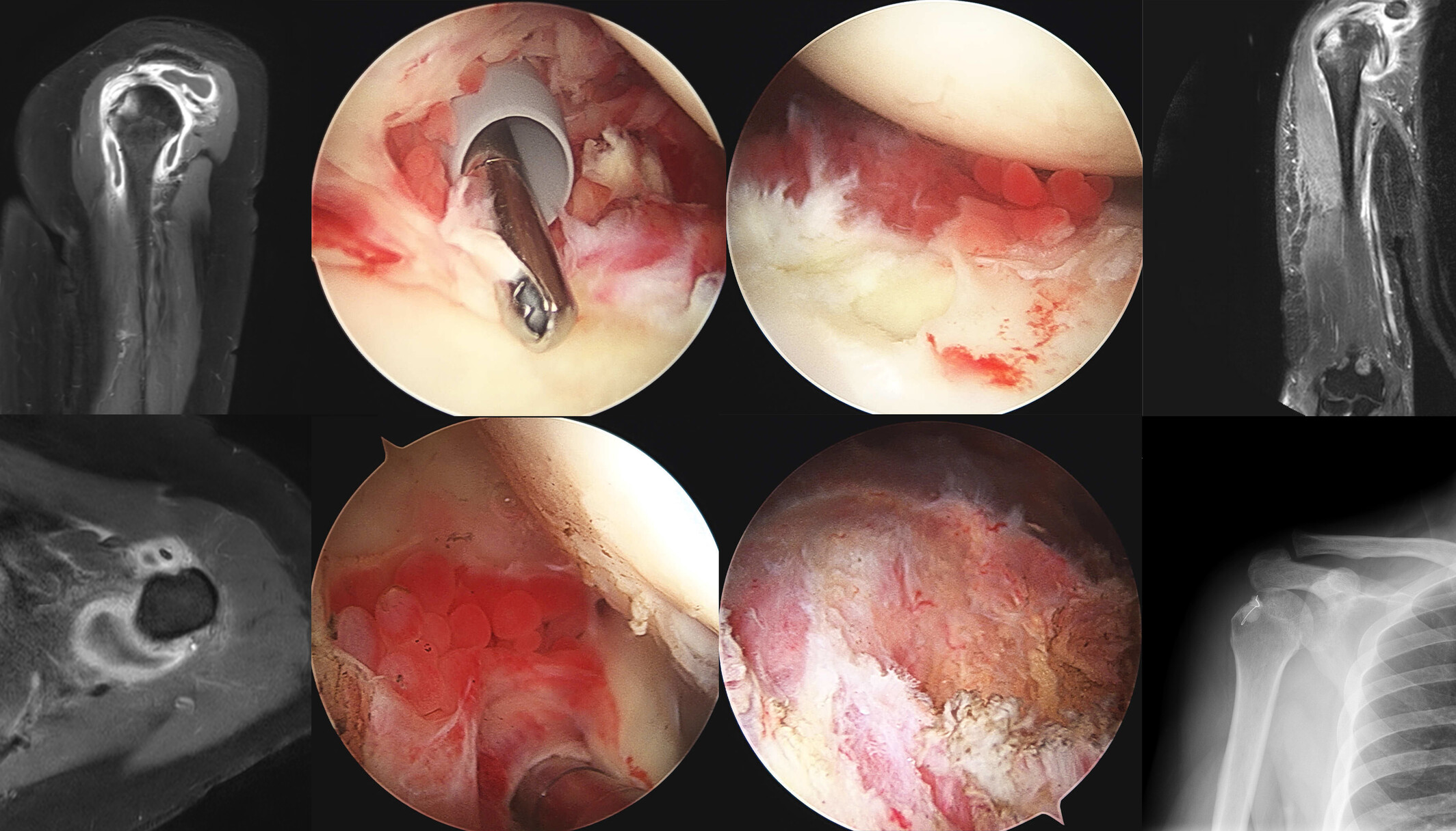 Extra-Articular Abscess Expansion as a Specific Complication of Septic Arthritis of the Shoulder Joint: Report of Three Cases with Extension of the Infection through the Biceps Groove Producing a Large Abscess