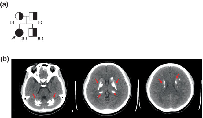 Fahr's disease linked to a novel mutation in MYORG variants manifesting as paroxysmal limb stiffness and dysarthria: Case report and literature review