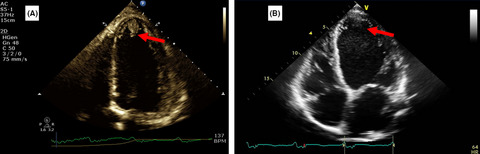 Use of direct oral anticoagulants in the treatment of left ventricular thrombi: A tertiary center experience and review of the literature