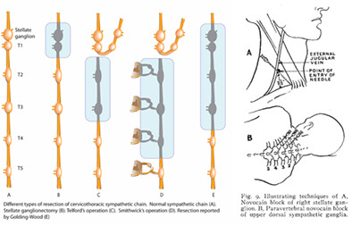 Historical Therapies for Suspected Autonomic Dysregulation in Meniere's Disease