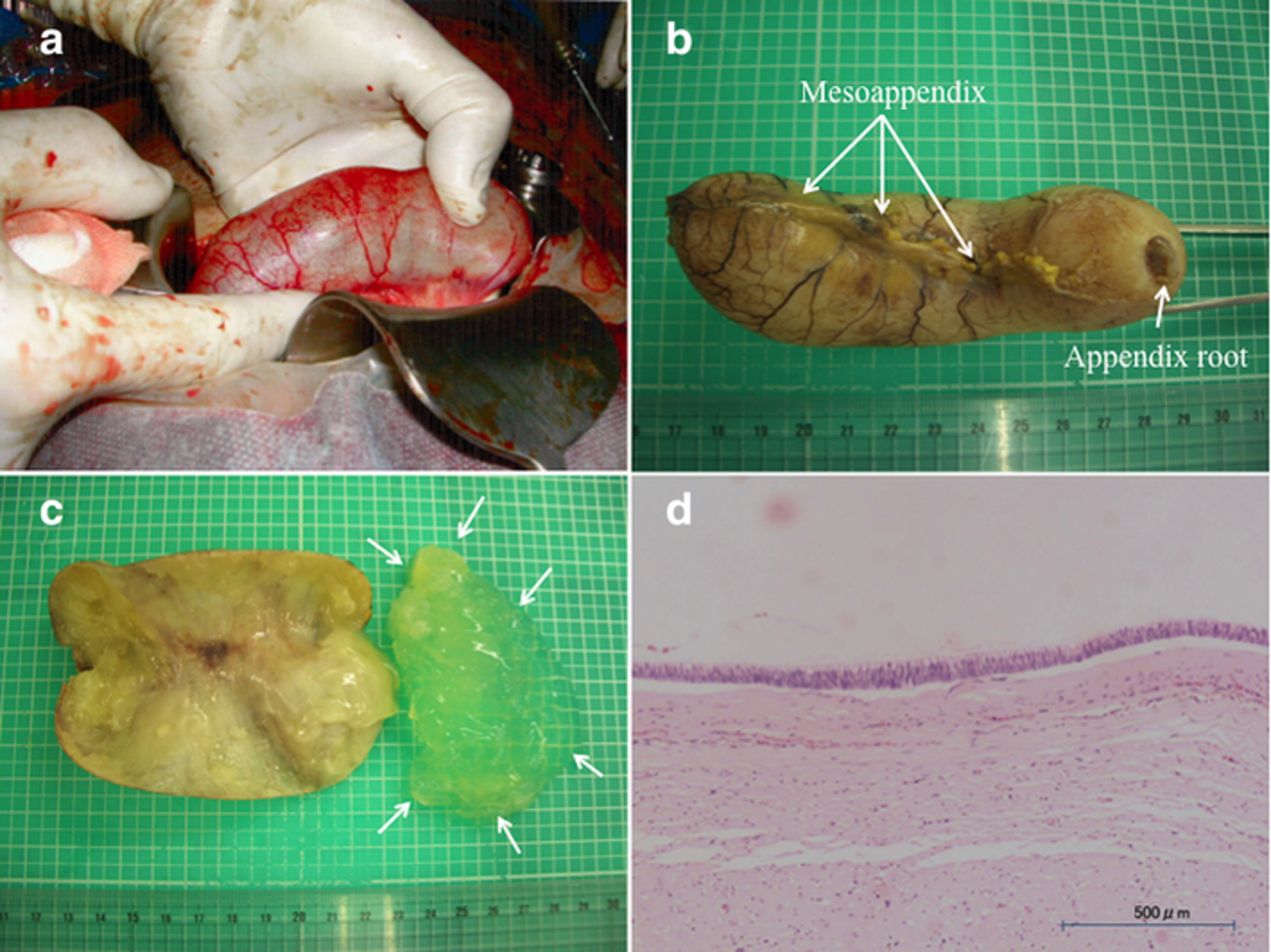 An incidental finding of low-grade appendiceal mucinous neoplasm during cesarean section: A case report