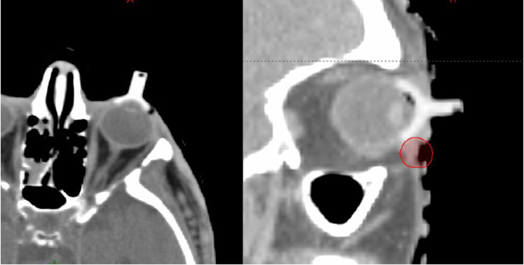 Evaluation of the clinical outcomes and patient satisfaction related to the use of internal eye shields for electron external beam radiation therapy