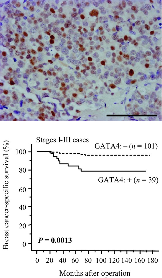 GATA4 immunolocalization in breast carcinoma as a potent prognostic predictor