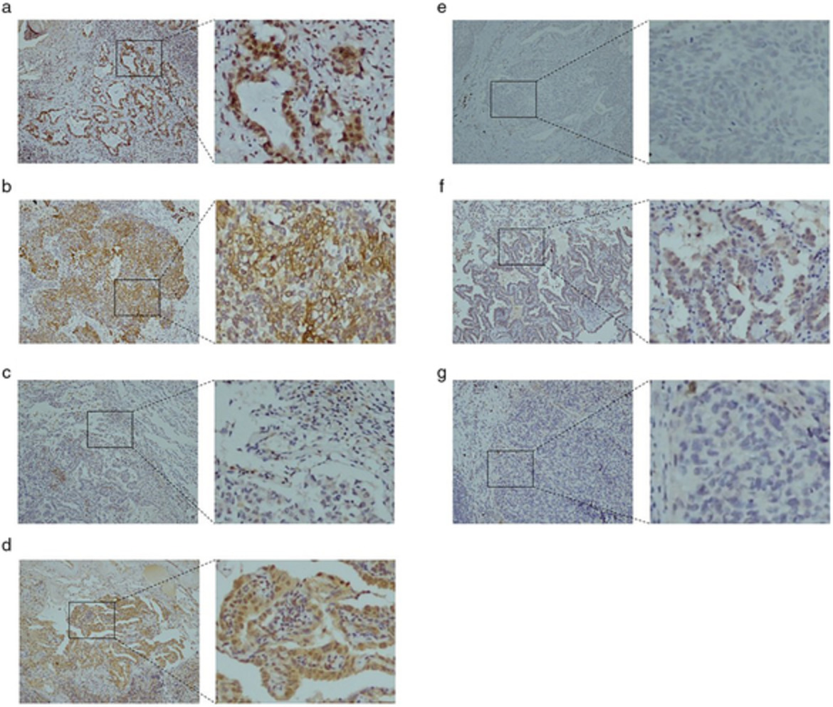 Correlation between CXCR4, CXCR5 and CCR7 expression and survival outcomes in patients with clinical T1N0M0 non-small cell lung cancer