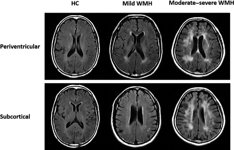 Retinal sublayer defect is independently associated with the severity of hypertensive white matter hyperintensity