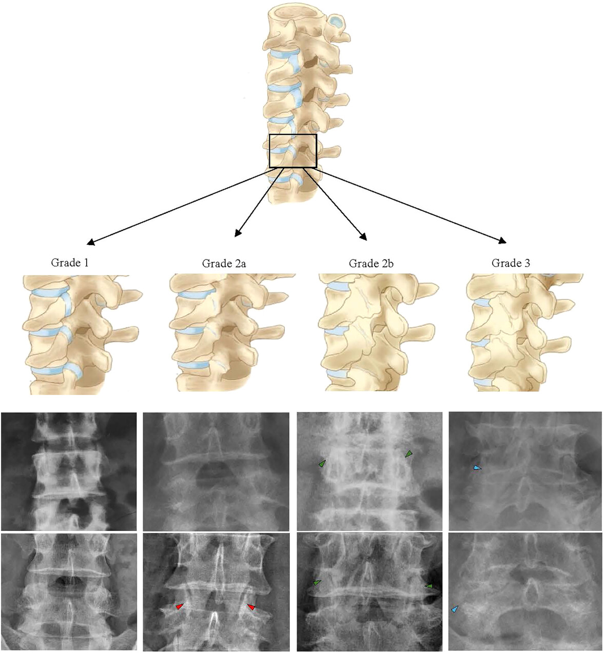 Enhancing Clinical Insights: New Radiographic Grading for Lumbar Facet Joint Degeneration, A Reliability Study