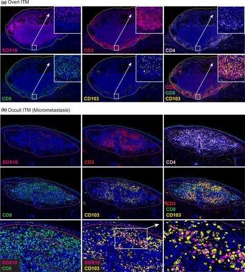Accumulation of CD103+ CD8+ T cells in a cutaneous melanoma micrometastasis