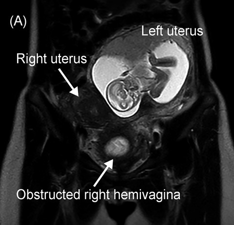 Successful pregnancy outcome in Herlyn-Werner-Wunderlich syndrome with pyocolpos: A case report and literature review