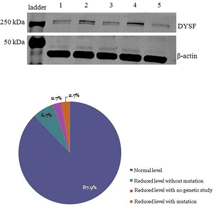 Genetic and Epigenetic Determinants of Low Dysferlin Expression in Monocytes