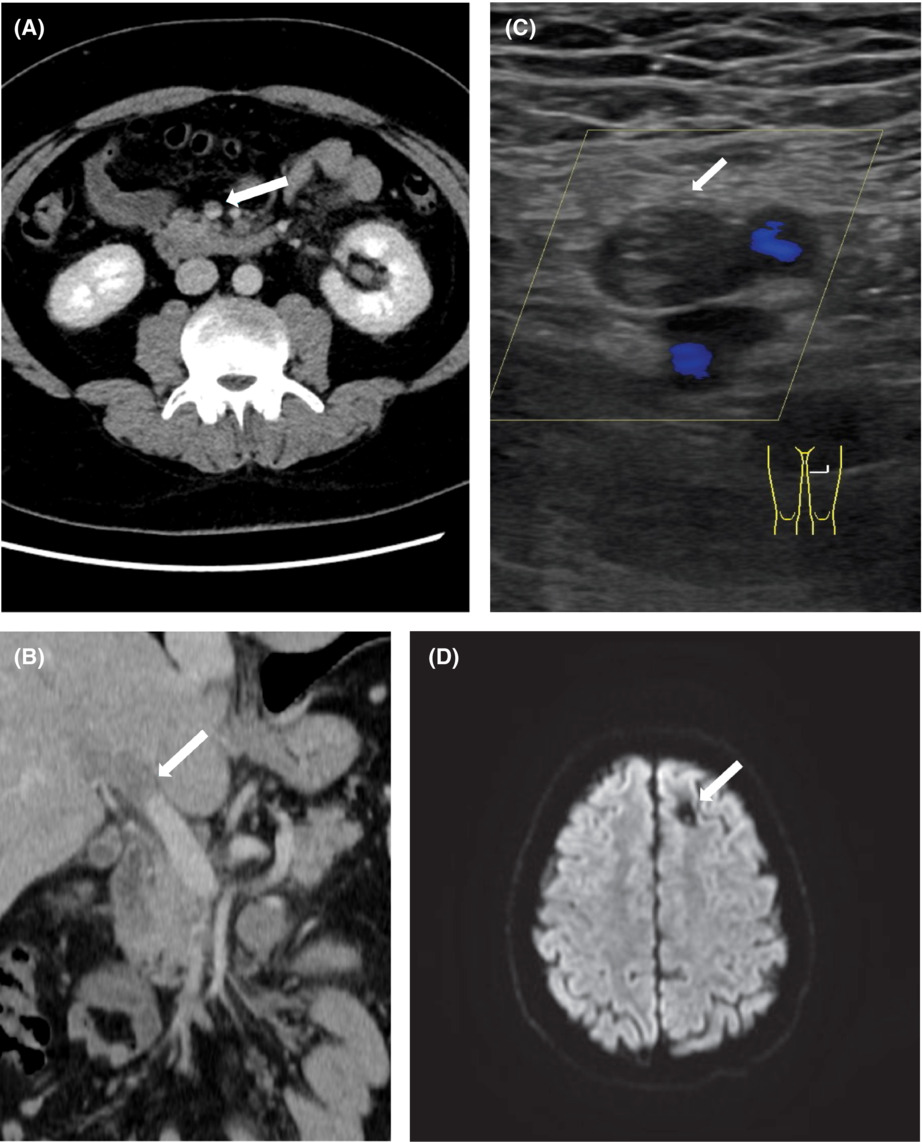 Vaccine-induced immune thrombotic thrombocytopenia (VITT) after SARS-CoV-2 vaccination: Two cases from Germany with unusual presentation