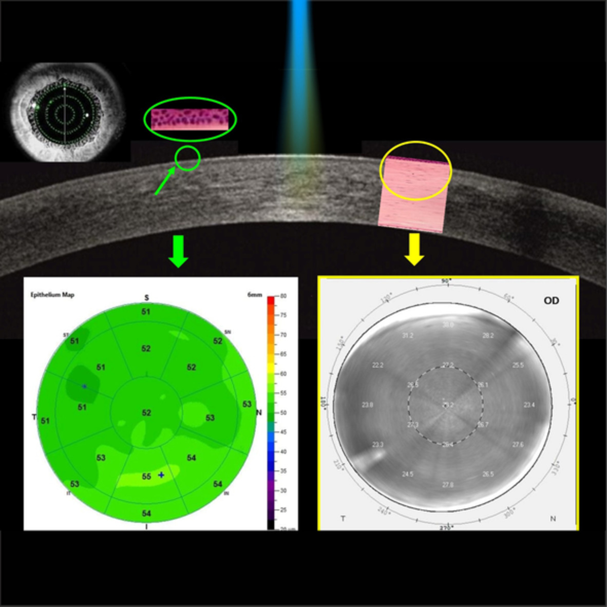 Evaluation of corneal structures in myopic eyes more than twenty-two years after photorefractive keratectomy