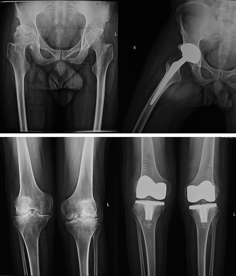 A Retrospective, Long-term Follow-up of the Clinical Outcomes and Cost-effectiveness of Single-anesthetic Multiple Total Joint Procedures in Hemophilic Arthropathy