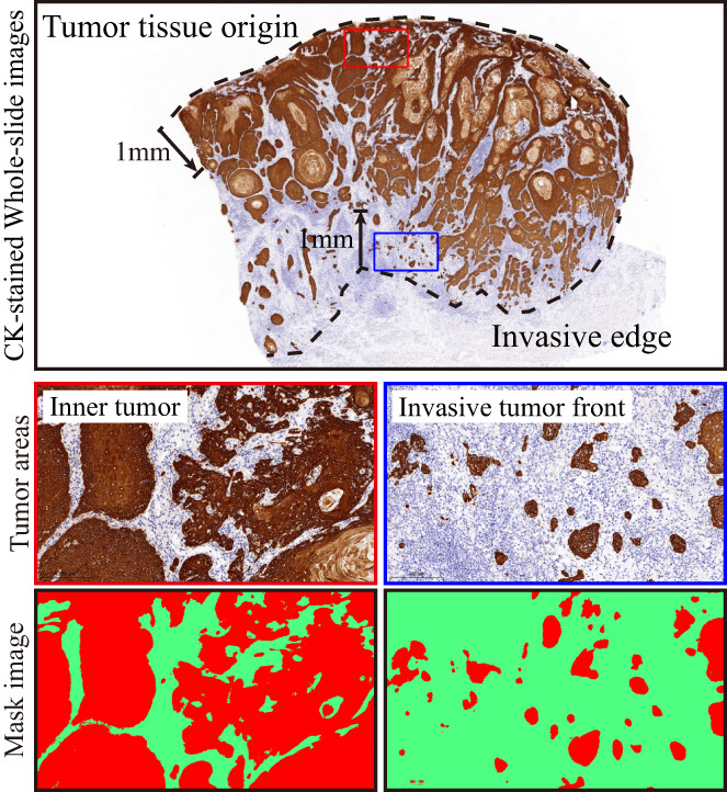 Multiperspective quantitative tumor–stroma ratio reveals histological areas associated with poor outcomes in oral squamous cell carcinoma